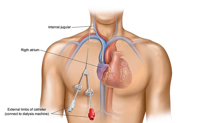 Central venous catheter